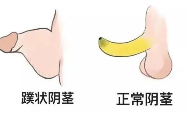 男科整形手术 让你重拾幸福——蹼状阴茎变形记